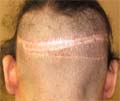 Hair transplant Chicago